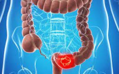 Khảo sát độc tính trên gan, thận của bệnh nhân ung thư đại trực tràng khi điều trị bằng phác đồ FOLFOX 4 tại khoa Hóa trị và nội ung bướu Bệnh viện Ung bướu năm 2020